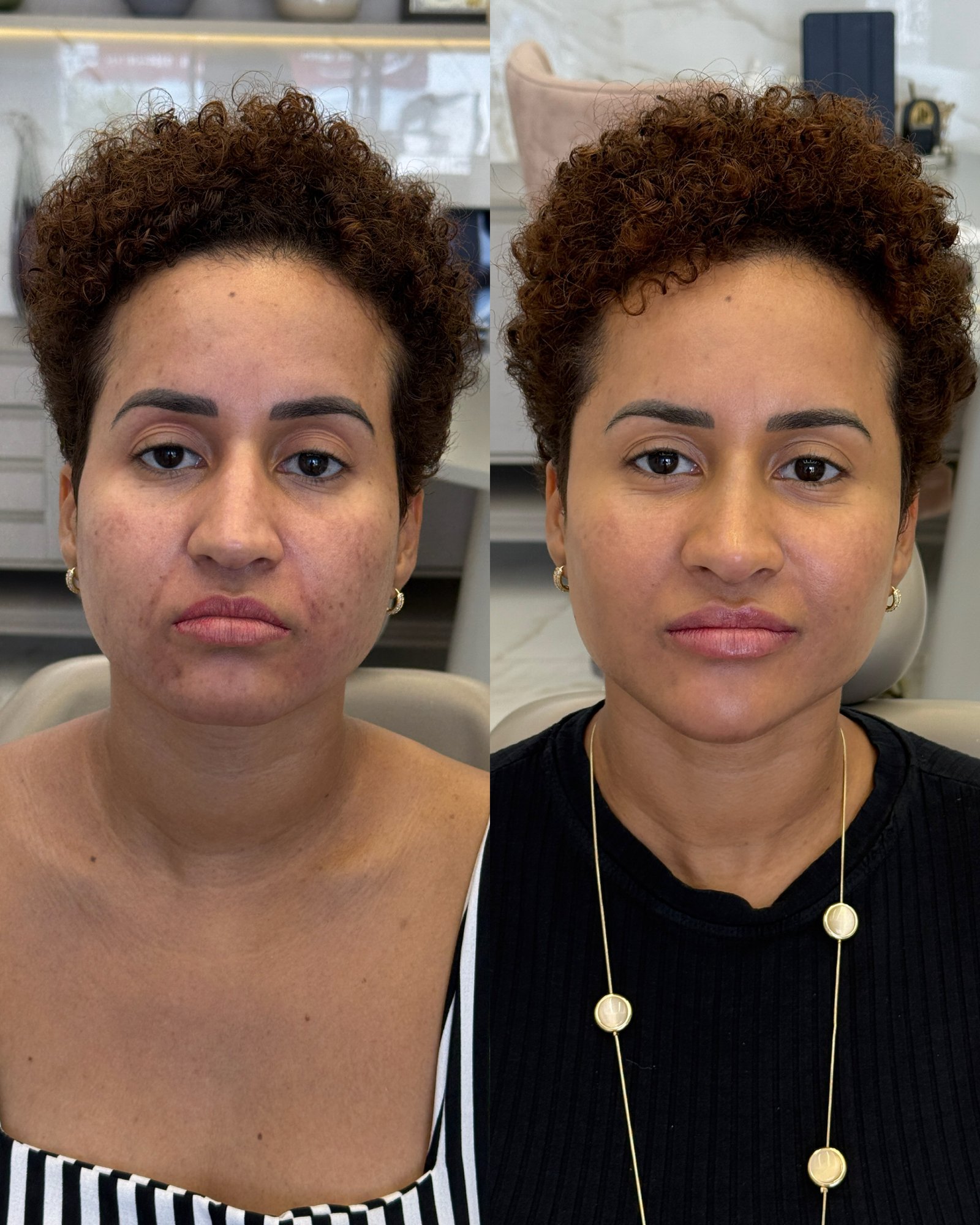 Foto frontal comparativa de harmonização facial, demonstrando o rejuvenescimento e estruturação do rosto da paciente.