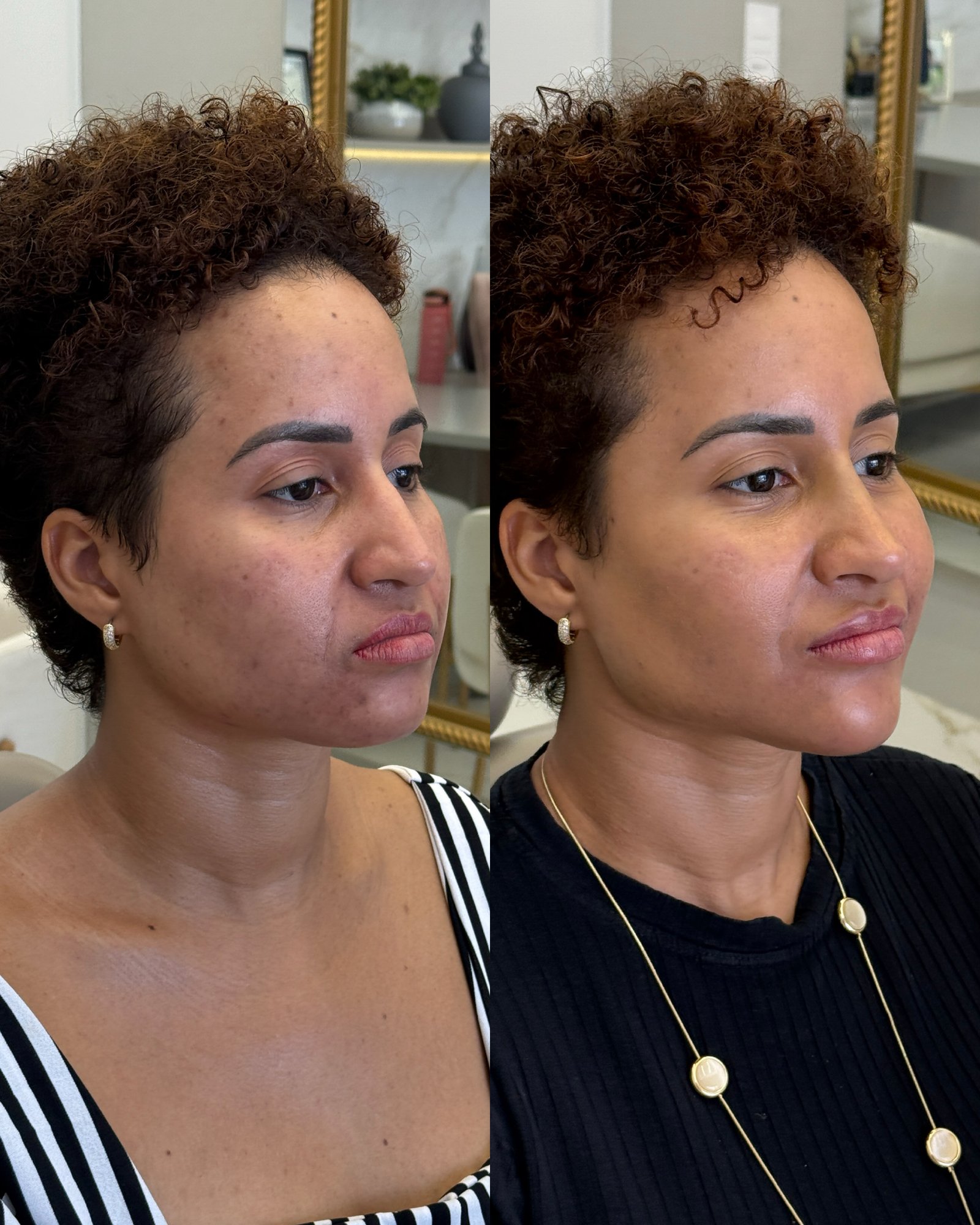 Vista lateral de paciente após procedimentos estéticos, com destaque para a linha da mandíbula mais desenhada e firme.