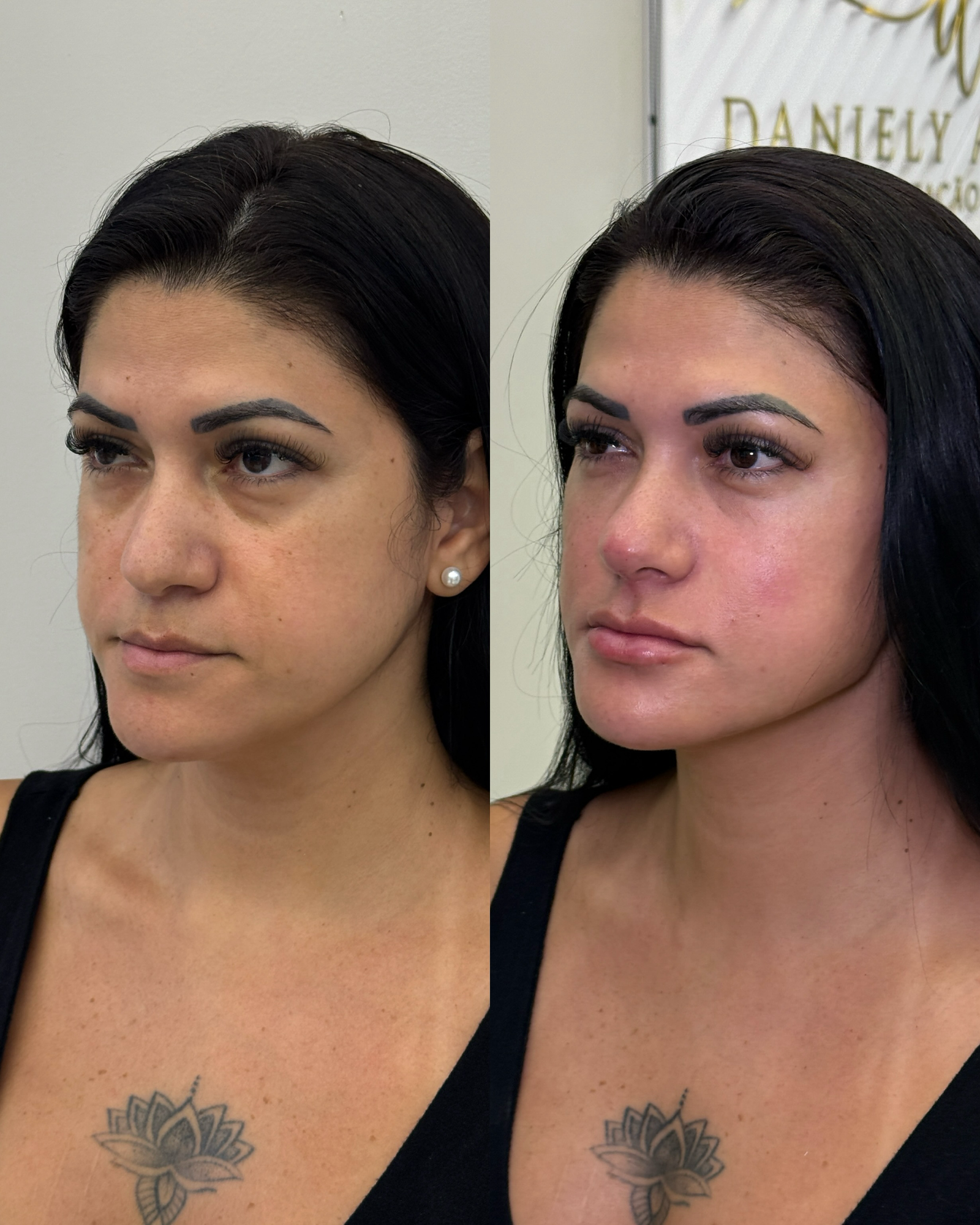 Antes e depois de harmonização facial em ângulo 3/4, destacando a definição do contorno da mandíbula e efeito lifting natural.