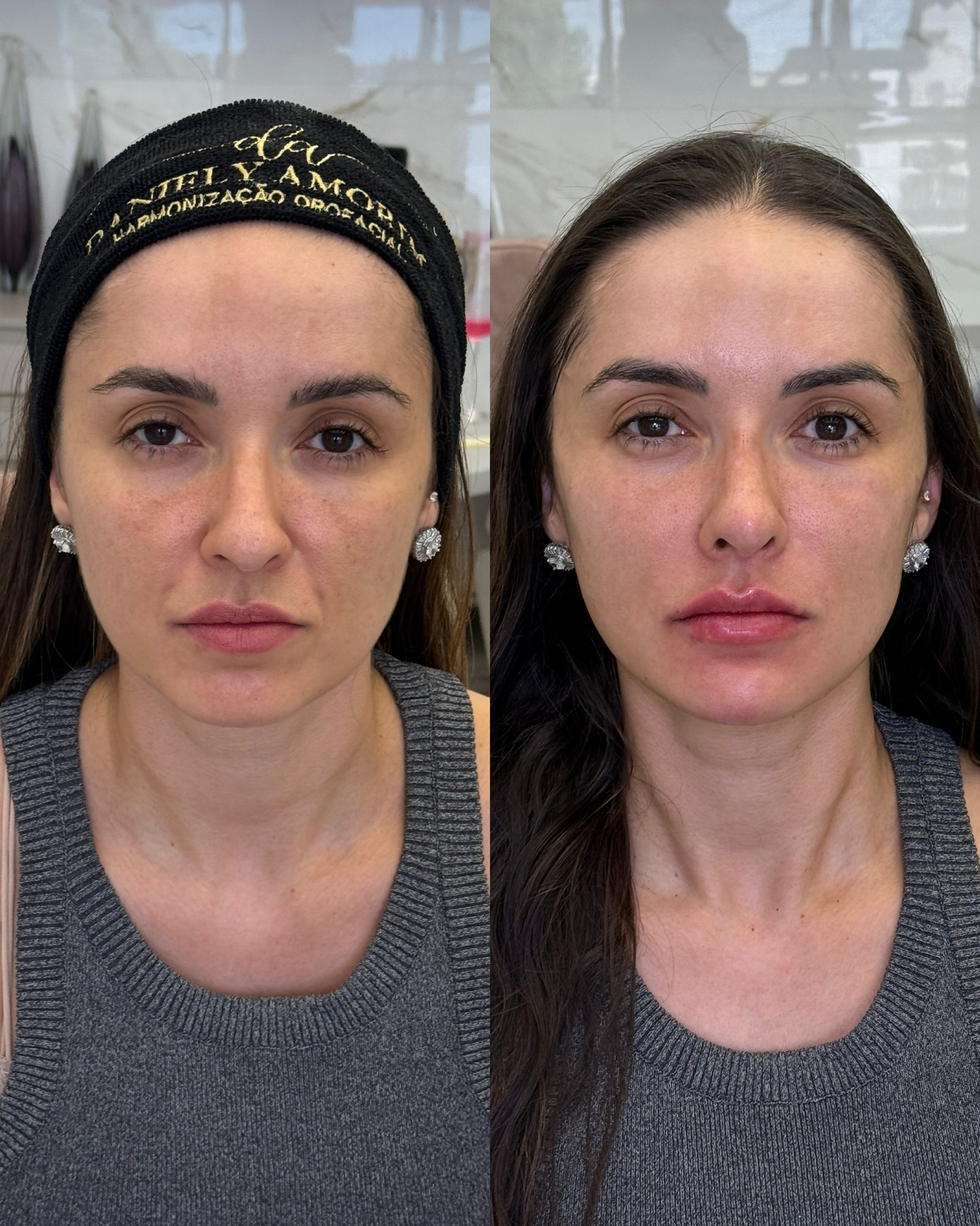 Comparativo frontal de rejuvenescimento facial, mostrando melhora na qualidade da pele e simetria do rosto.