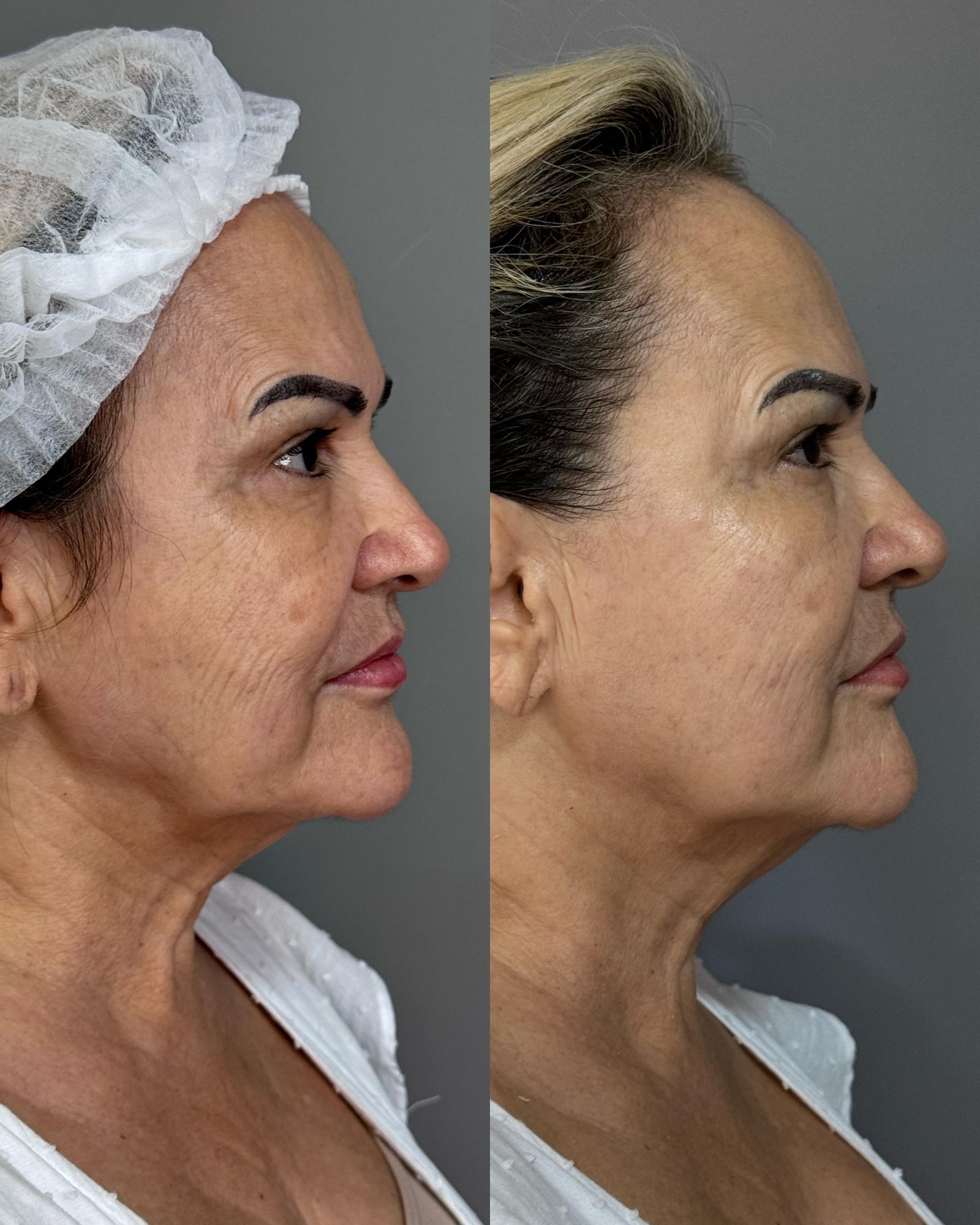Tratamento para pele madura: antes e depois de perfil evidenciando a redução da flacidez no pescoço e definição do contorno.