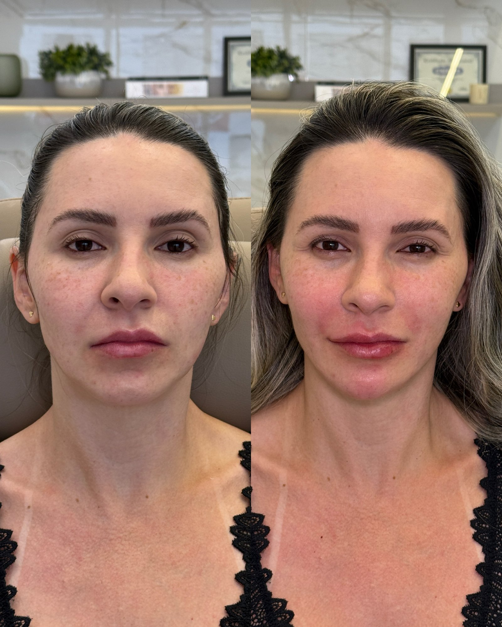 Resultado de Full Face frontal: harmonização completa com preenchimento labial, olheiras e estruturação facial.
