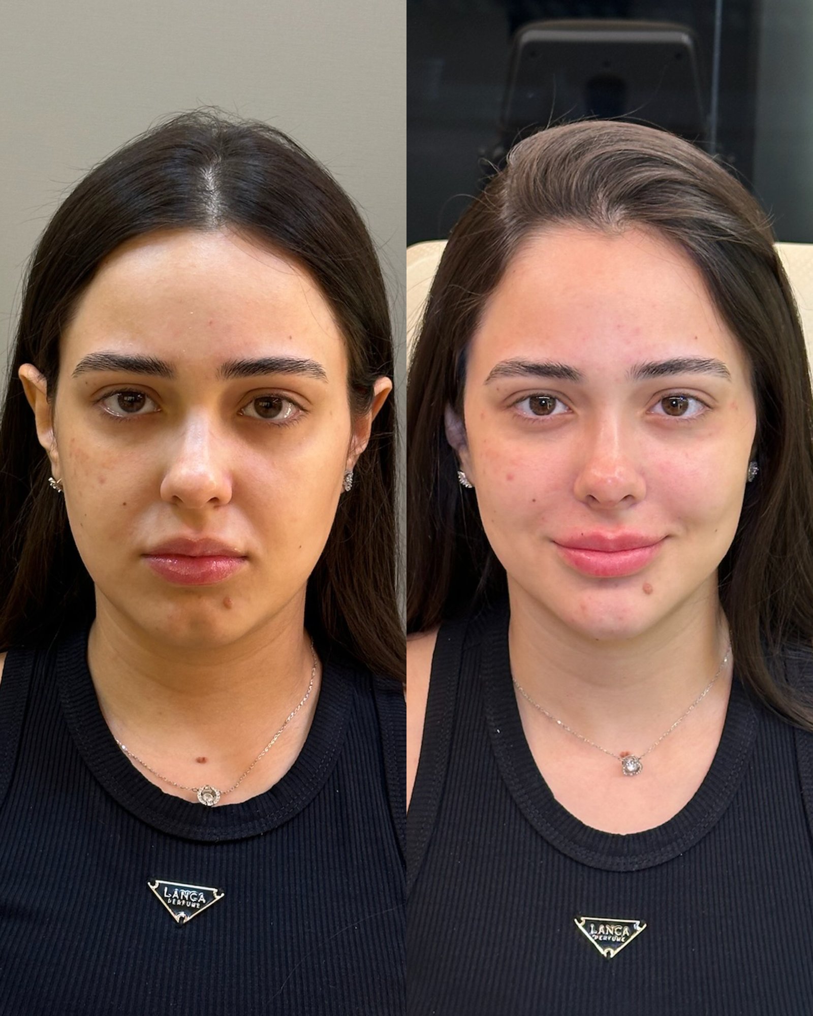 Close-up de lábios com preenchimento cicatrizado, mostrando detalhe da técnica de contorno e volume natural.