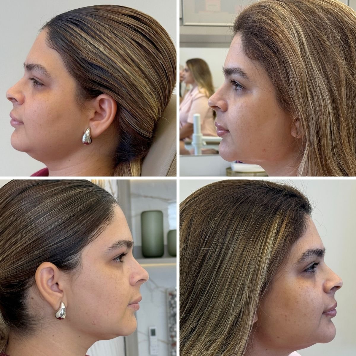Perfiloplastia completa: correção estética do nariz e projeção do queixo (mento) para harmonizar o perfil da paciente.